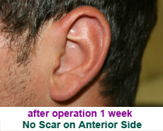 plastic-surgery-prominent-ear 